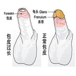 包皮过长